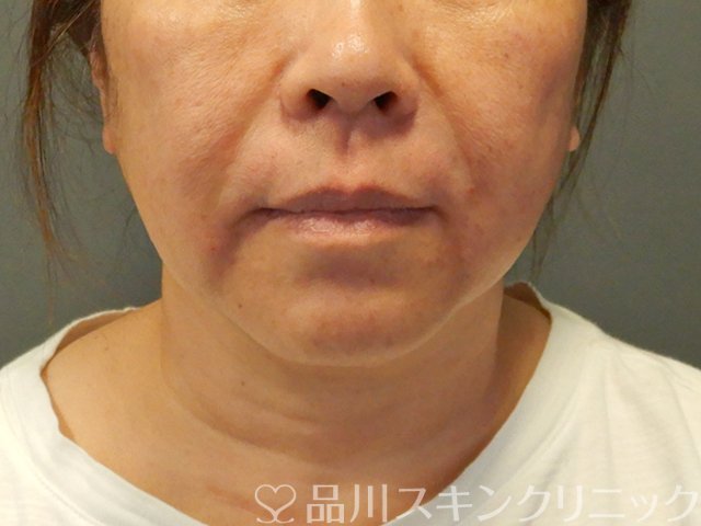 症例NO.66459のAFTER写真