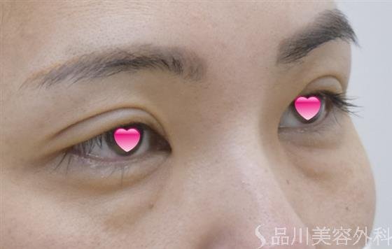 症例NO.52152のBEFORE写真
