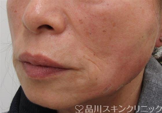 症例NO.40314のAFTER写真