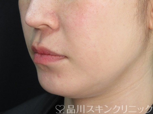 症例NO.71390のBEFORE写真