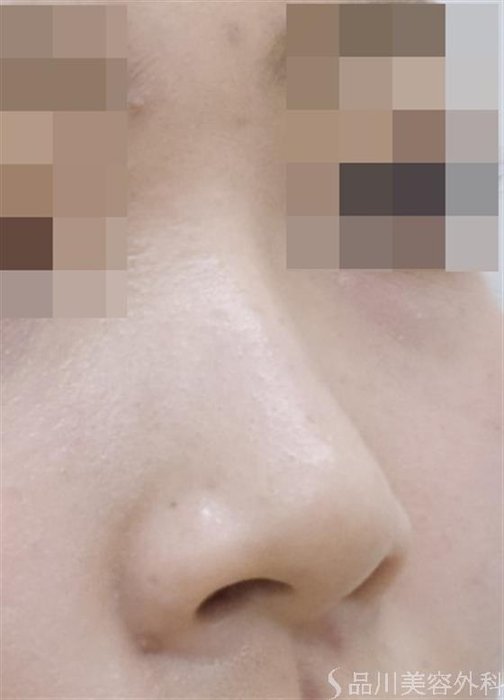 症例NO.51176のBEFORE写真