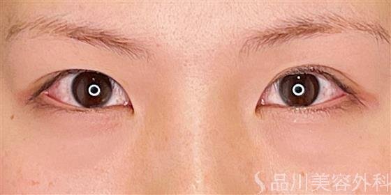 症例NO.54590のBEFORE写真