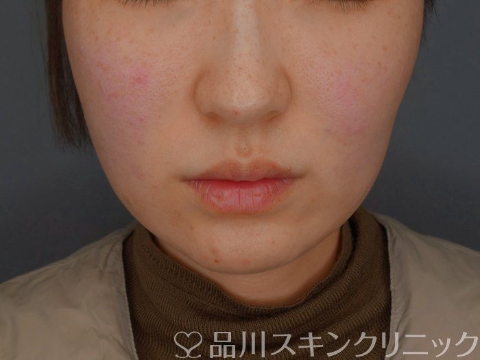 症例NO.74363のAFTER写真
