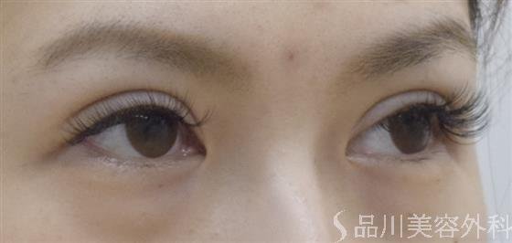 症例NO.52538のAFTER写真