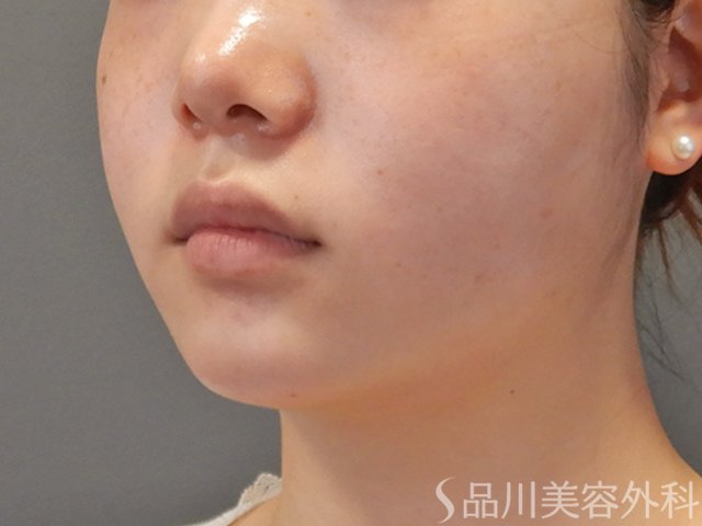 症例NO.75230のAFTER写真