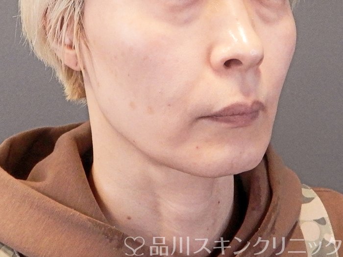 症例NO.63541のBEFORE写真