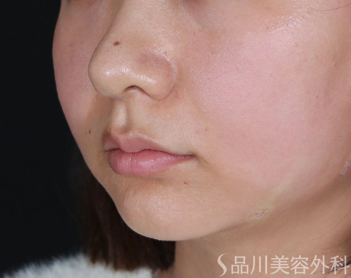 症例NO.71998のAFTER写真