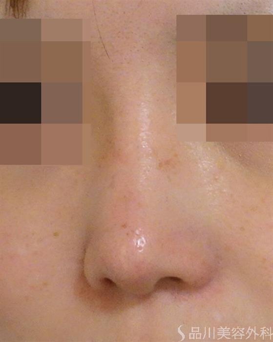 症例NO.39018のAFTER写真