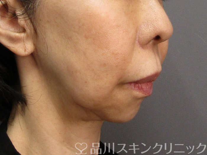 症例NO.75101のBEFORE写真