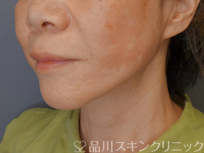 症例NO.71260のAFTER写真