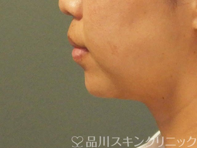 症例NO.66918のAFTER写真