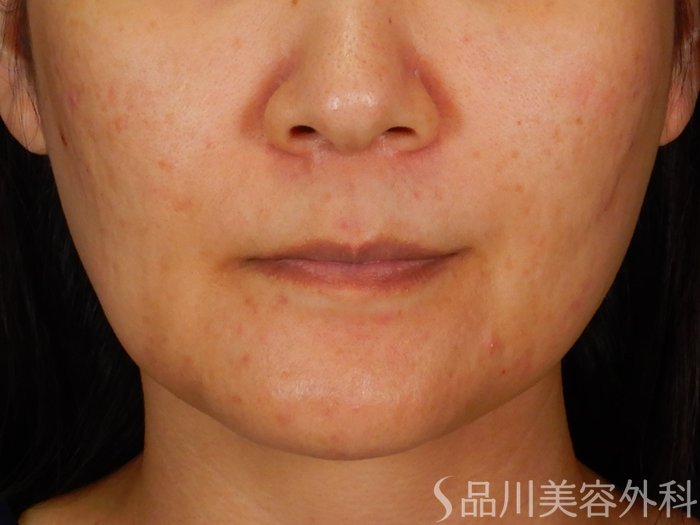 症例NO.68012のBEFORE写真