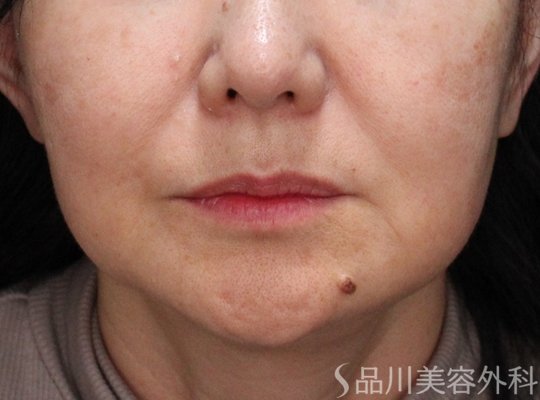 症例NO.74526のBEFORE写真