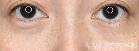 症例NO.71848のBEFORE写真