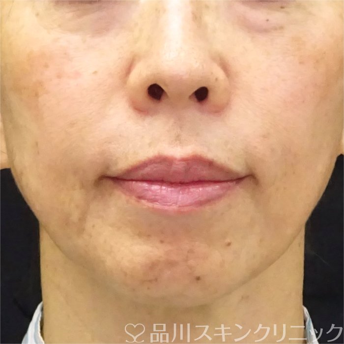 症例NO.69508のBEFORE写真