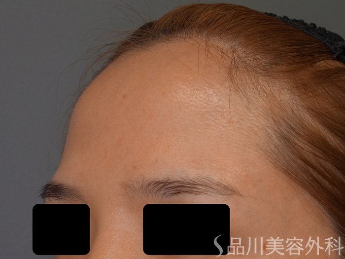 症例NO.67591のBEFORE写真
