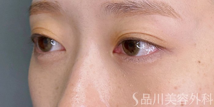 症例NO.74760のAFTER写真