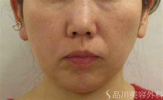 症例NO.59085のBEFORE写真