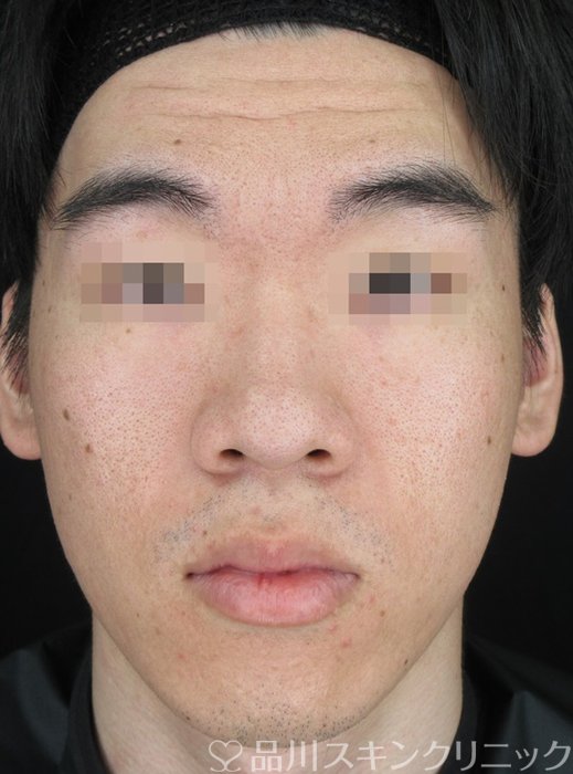 症例NO.70363のBEFORE写真
