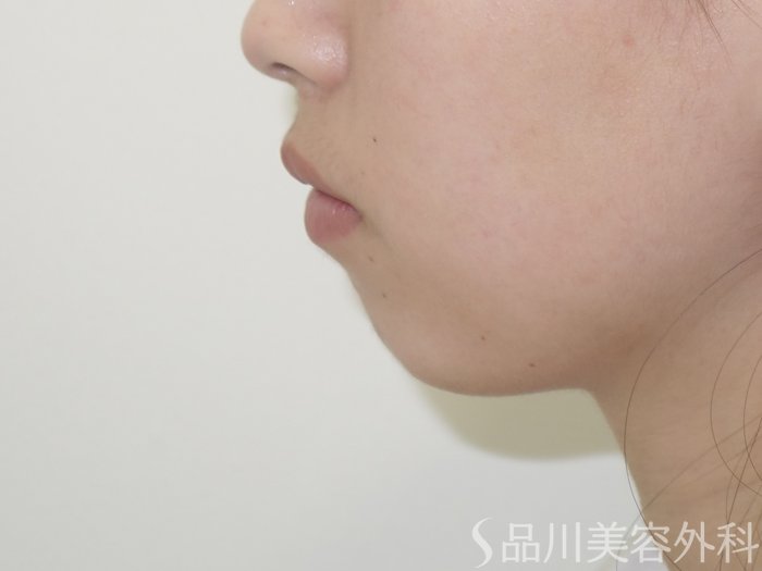 症例NO.69528のBEFORE写真