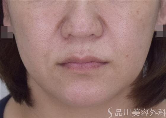 症例NO.50469のBEFORE写真