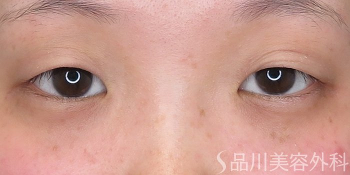 症例NO.71398のBEFORE写真