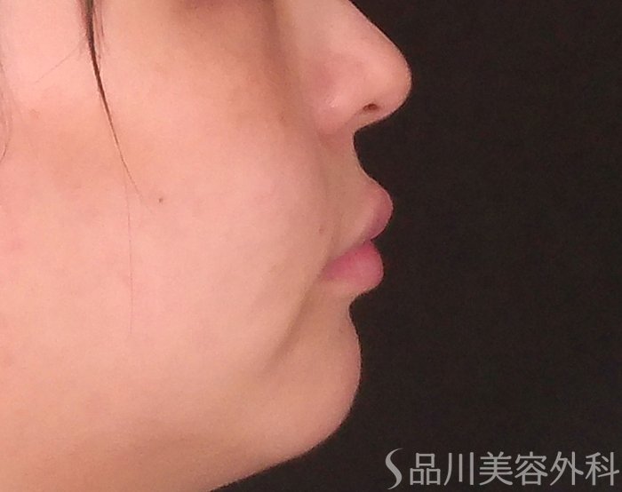 症例NO.70525のBEFORE写真