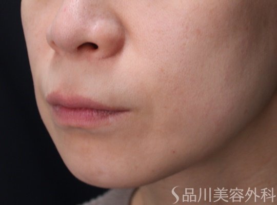 症例NO.69864のBEFORE写真