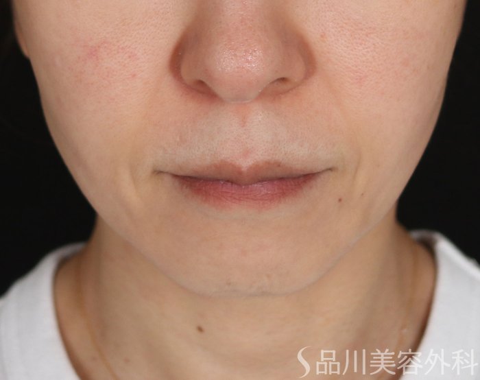 症例NO.74625のBEFORE写真