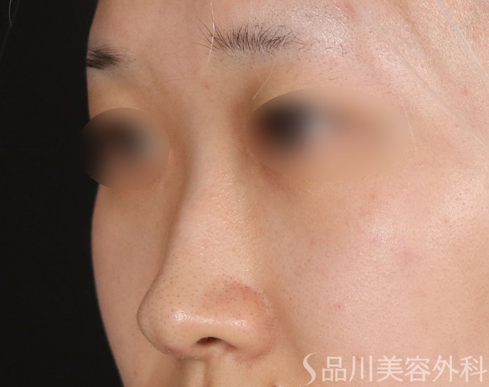 症例NO.73226のBEFORE写真