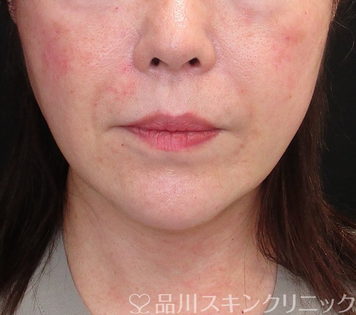 症例NO.73418のAFTER写真