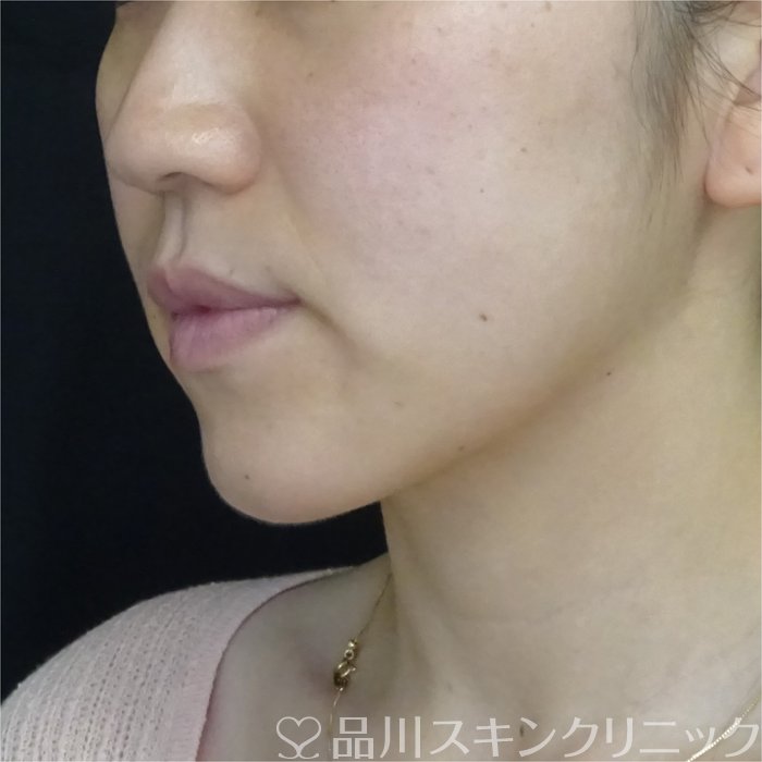 症例NO.69907のBEFORE写真