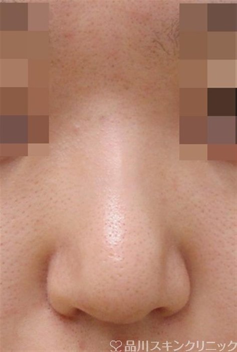 症例NO.38643のAFTER写真