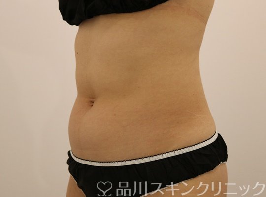 症例NO.71103のBEFORE写真