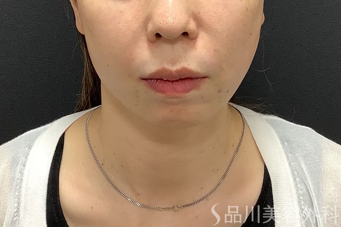 症例NO.75291のAFTER写真