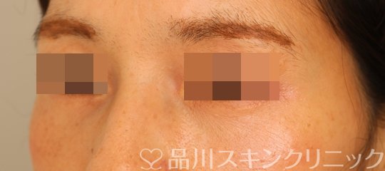 症例NO.71055のAFTER写真