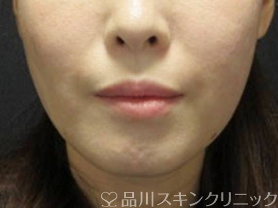 症例NO.73501のAFTER写真