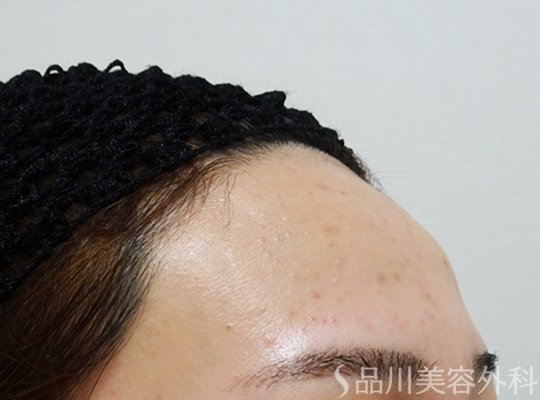 症例NO.71186のBEFORE写真