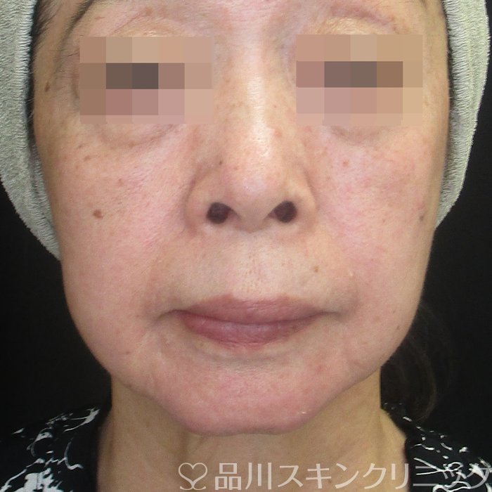 症例NO.73219のBEFORE写真