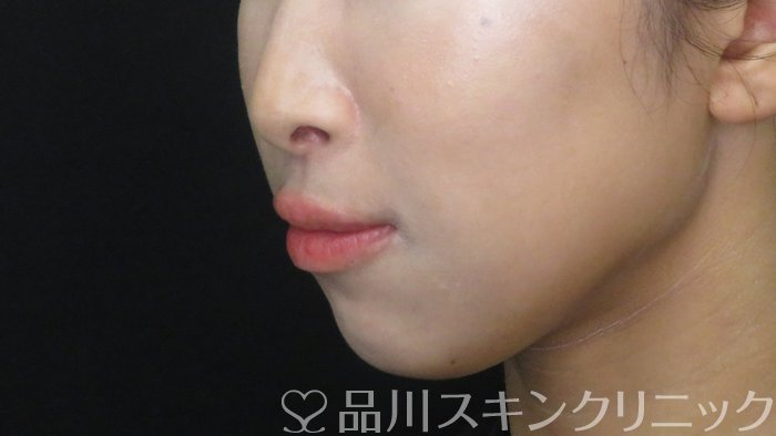 症例NO.72845のBEFORE写真