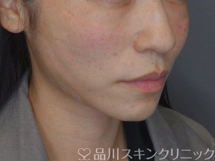 症例NO.74961のAFTER写真