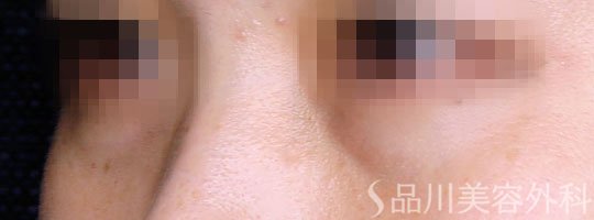 症例NO.74237のBEFORE写真