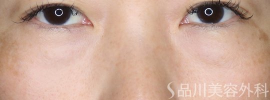 症例NO.74039のBEFORE写真