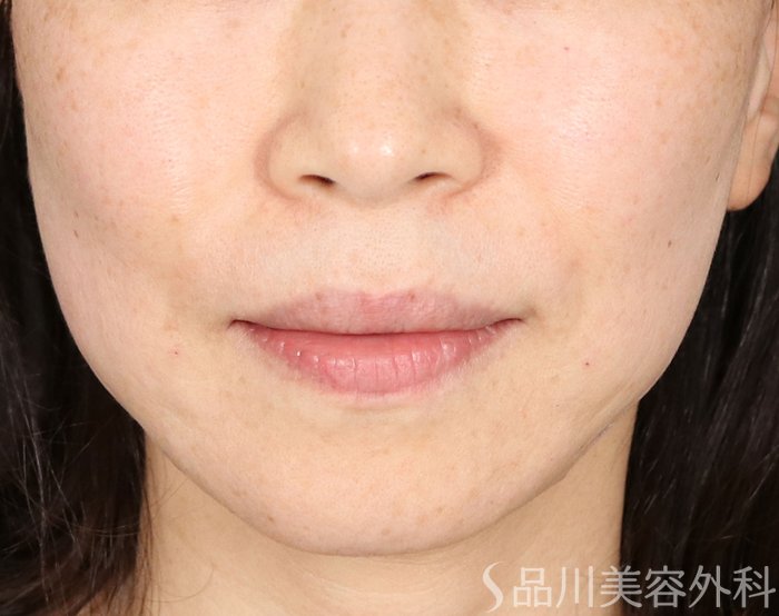 症例NO.71579のAFTER写真