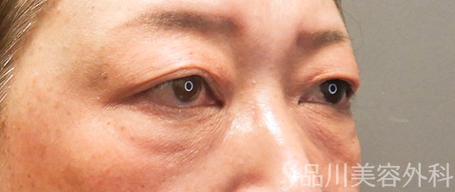 症例NO.69997のBEFORE写真
