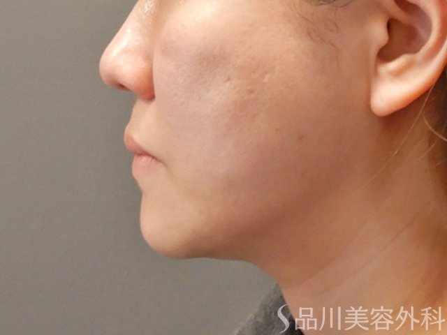 症例NO.75065のAFTER写真