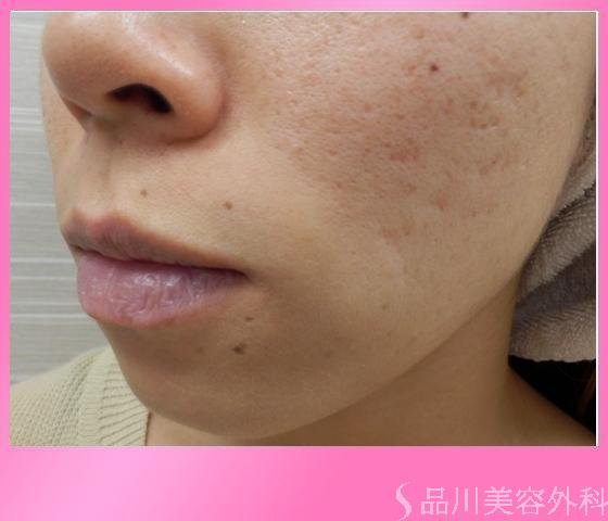 症例NO.11643のBEFORE写真