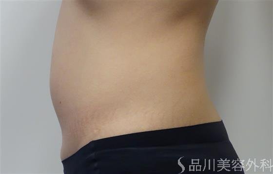症例NO.51448のBEFORE写真