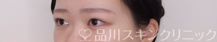 症例NO.69372のAFTER写真