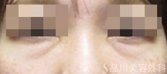 症例NO.73853のBEFORE写真